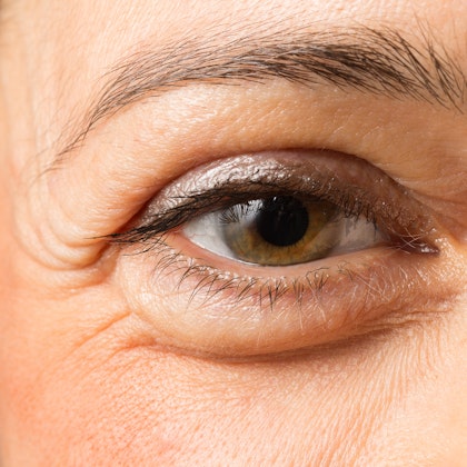 Eye with signs of aging