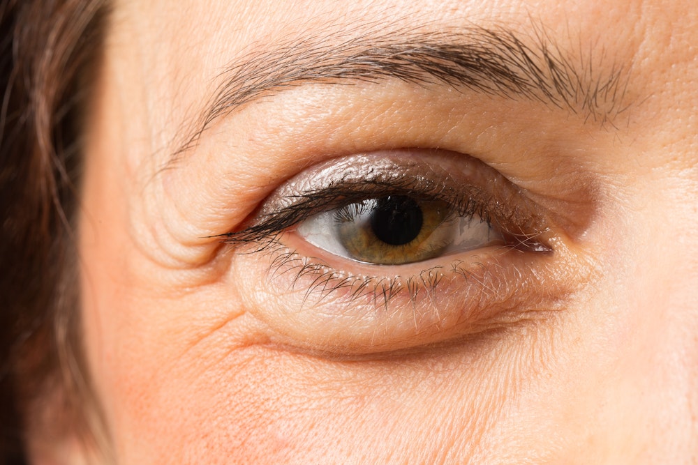 Fatty deposits on lower eyelid