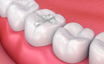 Illustration of dental filling