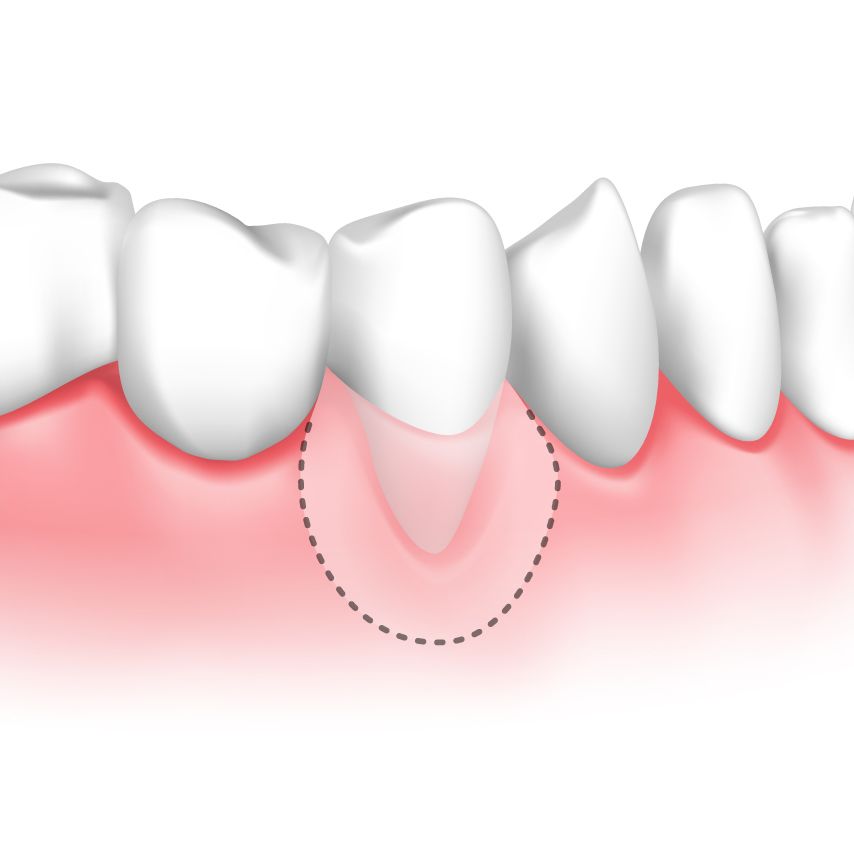 Illustration of gum graft