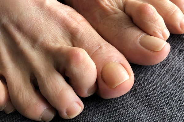 Hammertoe Affecting the Second Toe