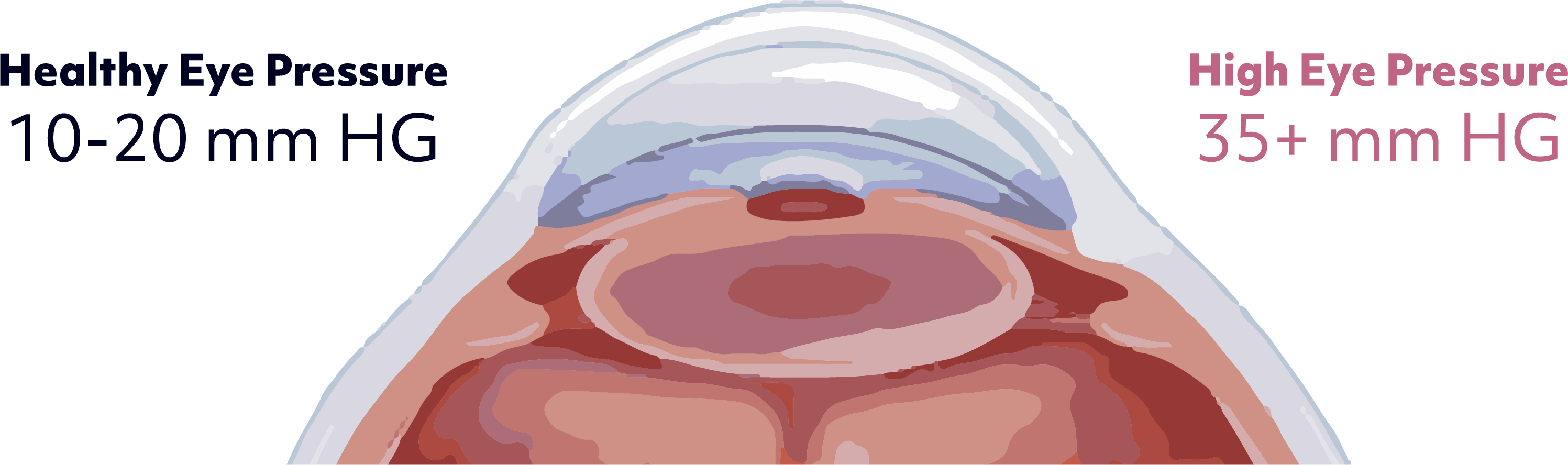 ​Healthy Eye Pressure: 10-20 mm HG, High Eye Pressure: 35+ mm HG