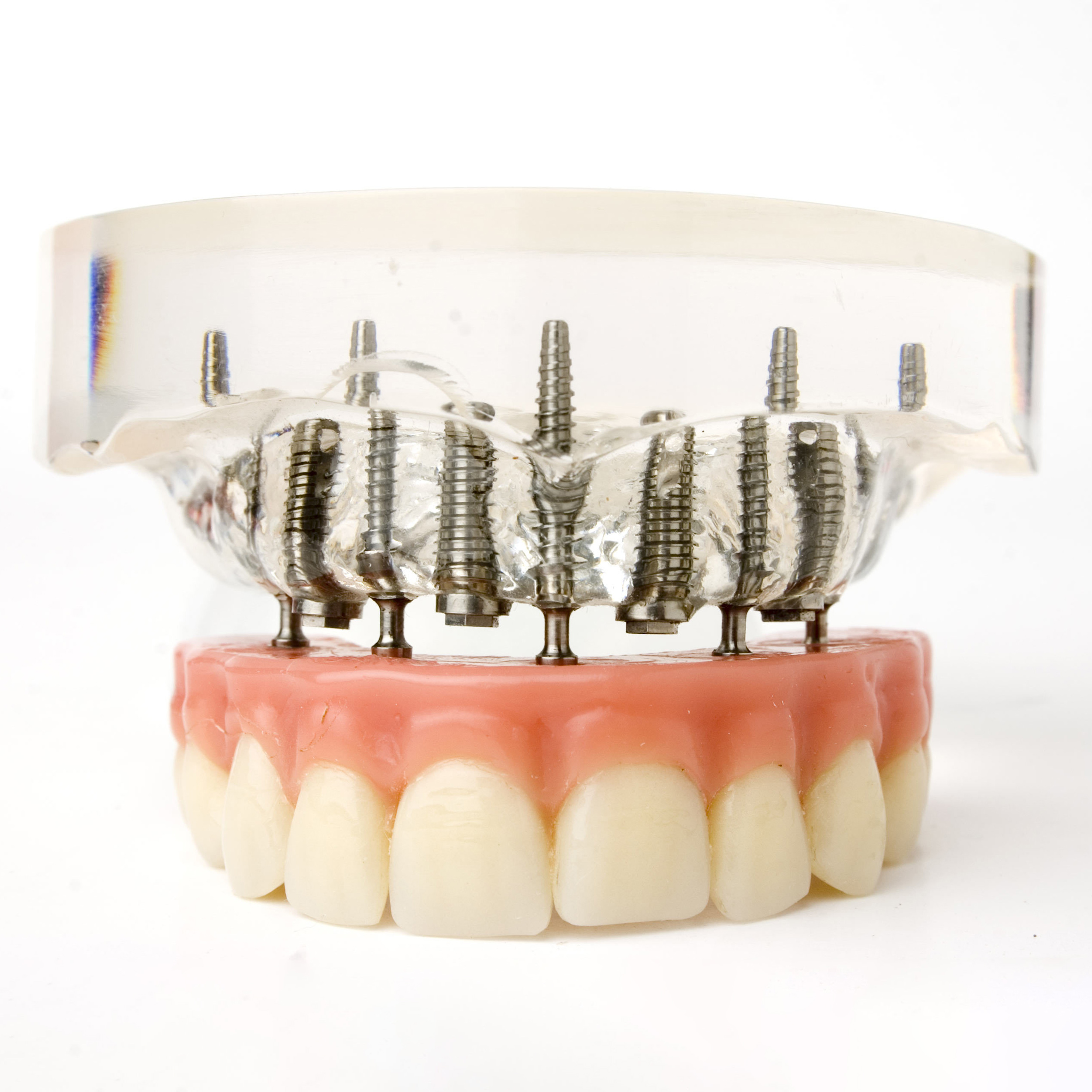 Implant-Supported Dentures