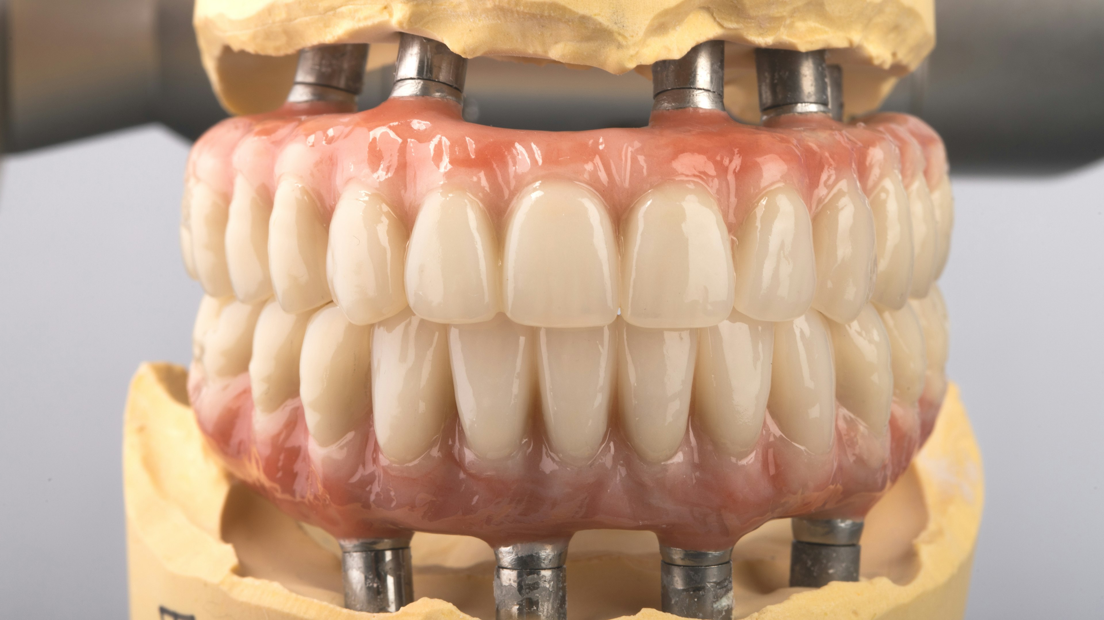 All-on-4 Dental implants