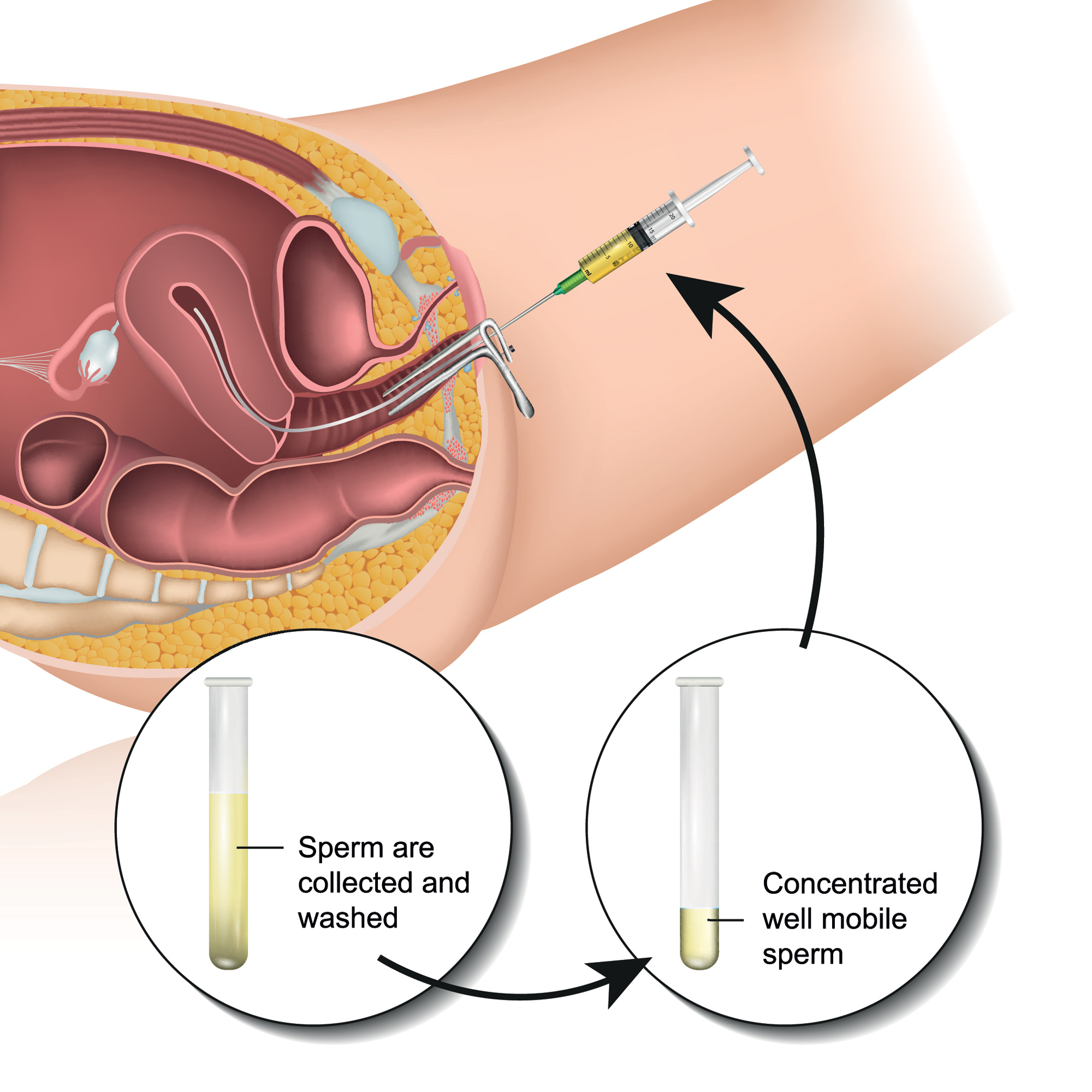 Symptoms of IUI Pregnancy  Signs of Intra Uterine Insemination