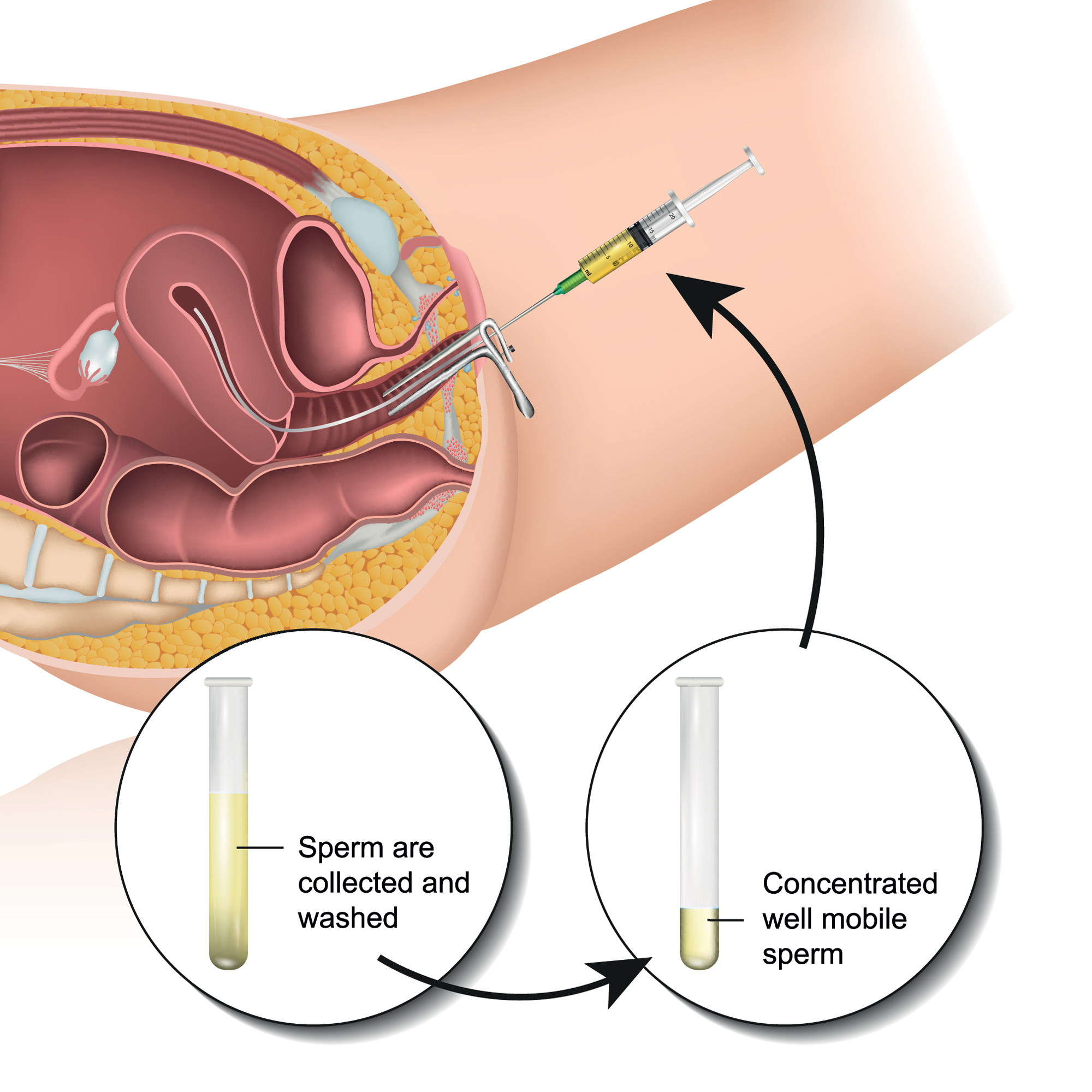 Ivf Iui