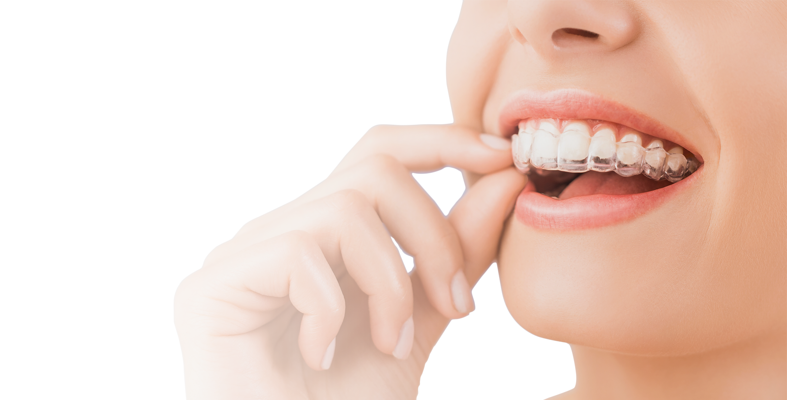 Get Your Invisalign Clear Braces at Our Ideal Smile Philadelphia