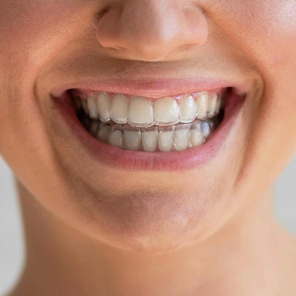 Lady wearing Invisalign