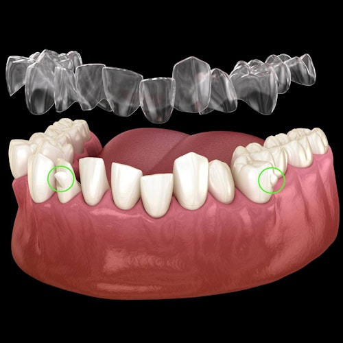 Teeth with attachments and Invisalign tray