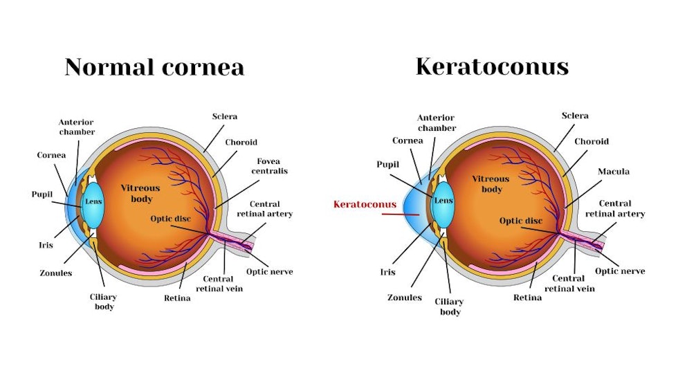 Side view comparison of normal eye and eye with keratoconus