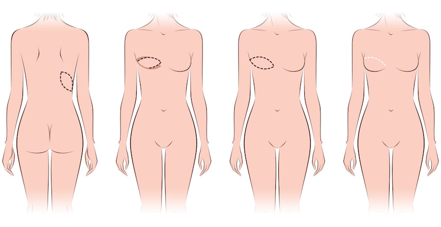 Illustration of latissimus dorsi flap breast reconstruction