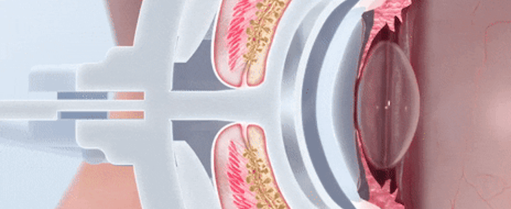 Lipiflow Animation