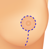 Illustration showing lollipop incision around area and down to crease