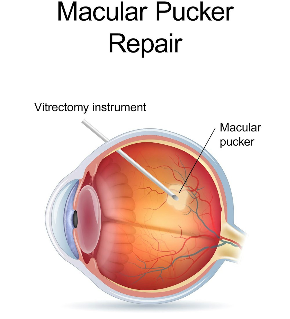 Macular Pucker Repair diagram with vitrectomy instrument taking out macular pucker