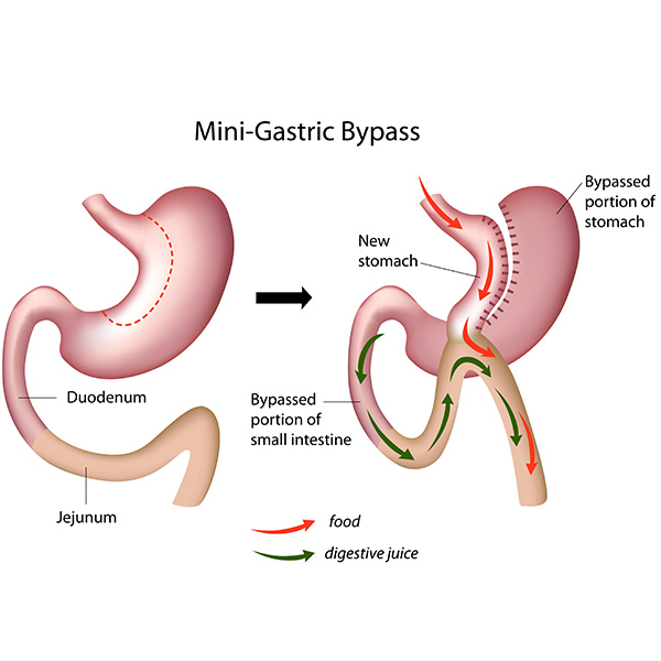 Illustration of mini gastric bypass