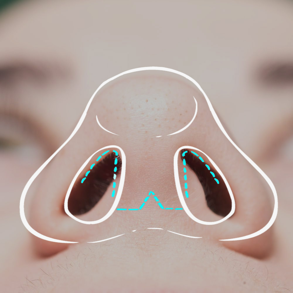 picture of nose with open rhinoplasty diagram over top