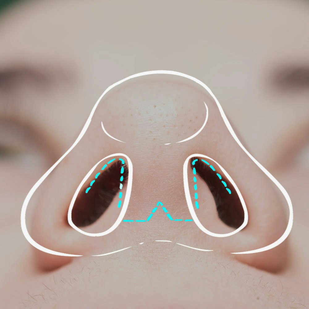 picture of nose with open rhinoplasty diagram over top