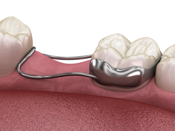 Orthodontic Space Maintainer