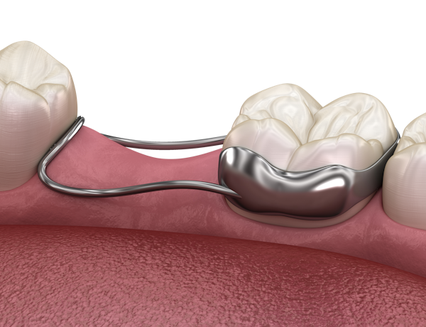 Orthodontic Space Maintainer