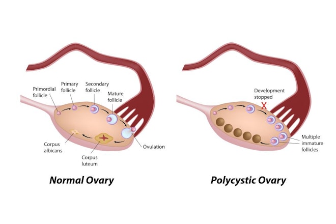 Diagram of normal versus a polycystic ovary. Polycystic ovaries have multiple immature follicles that have stopped development