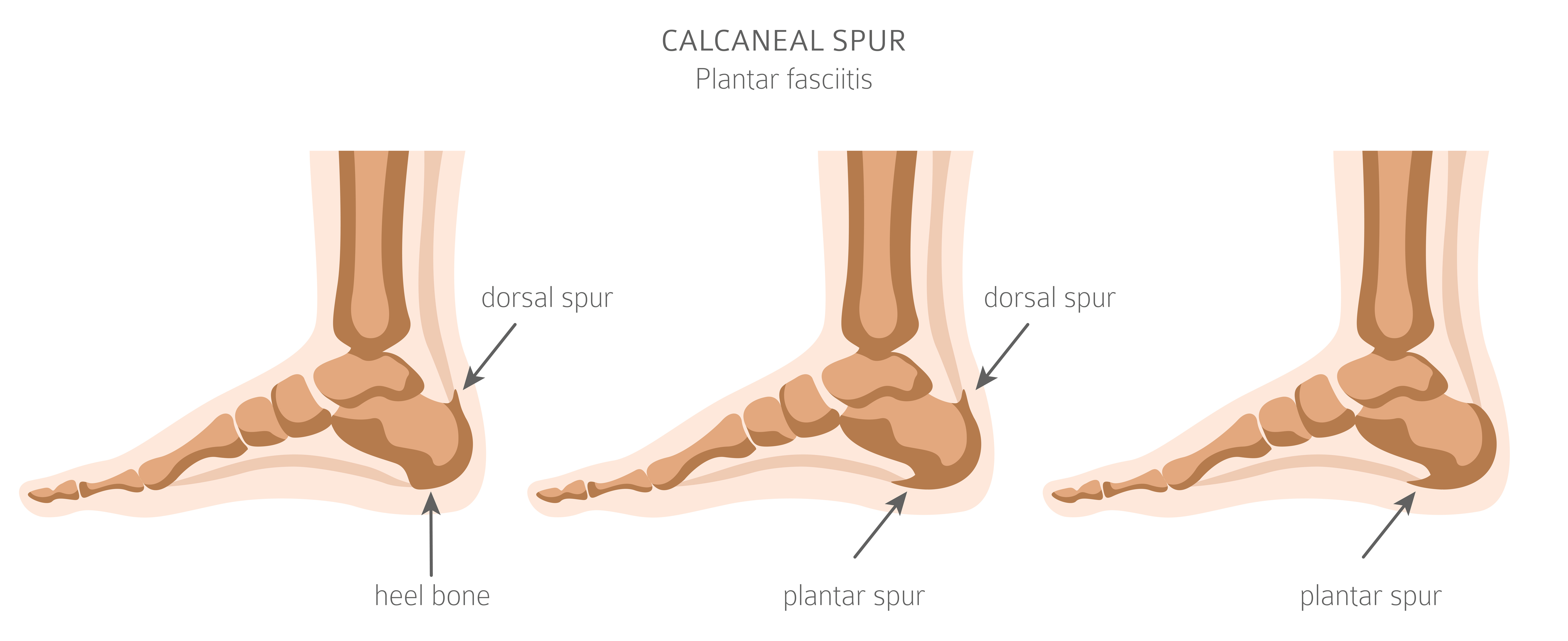 Calcaneal Osteotomy (Heel Bone Spur) – Yellowstone Surgery Center