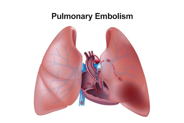 Illustration of a pulmonary embolism