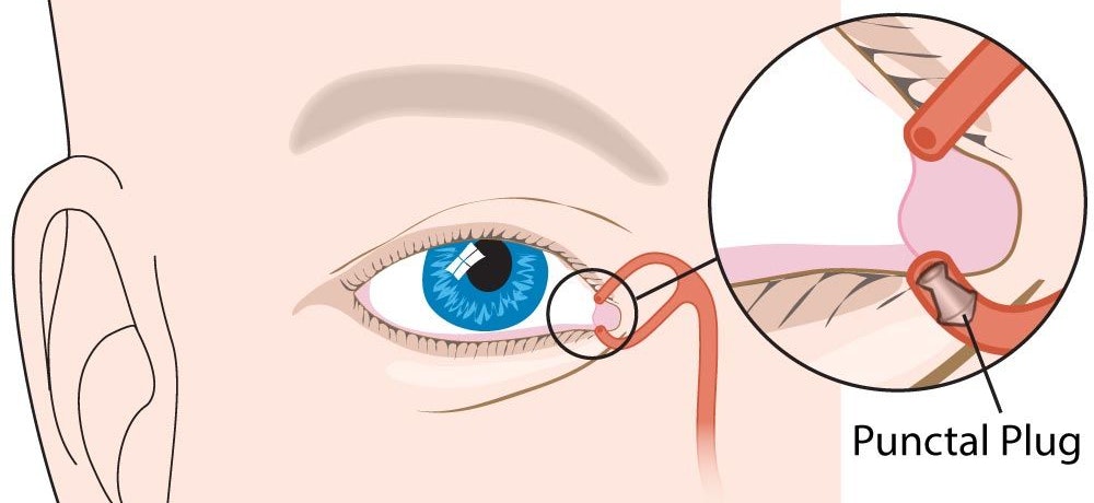 Punctal Plug Diagram