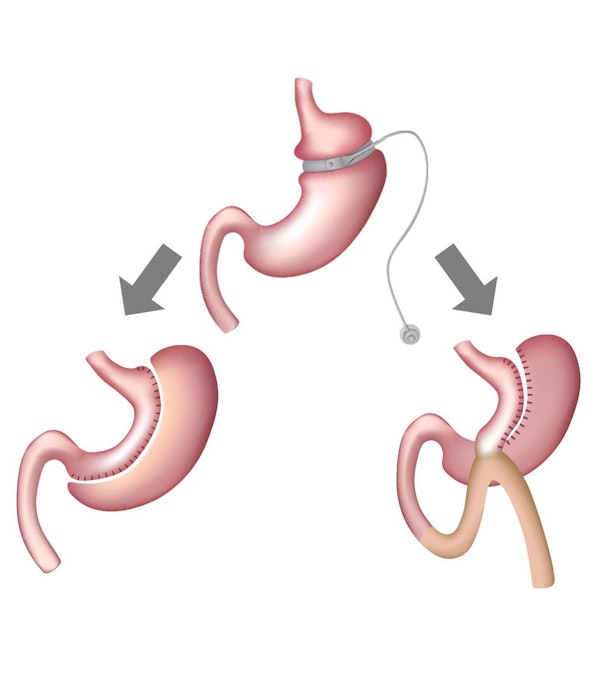 Different bariatric procedures