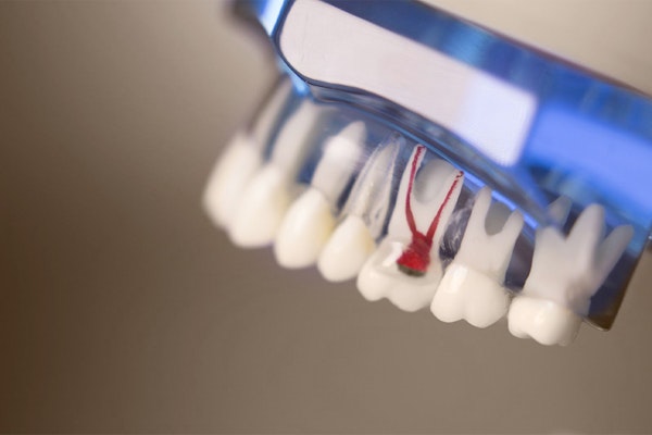 Model of infected root canals