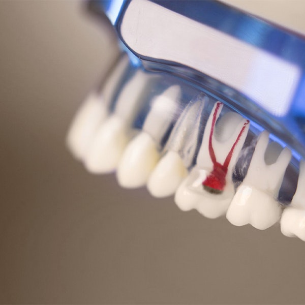 3d sculpture of a root canal