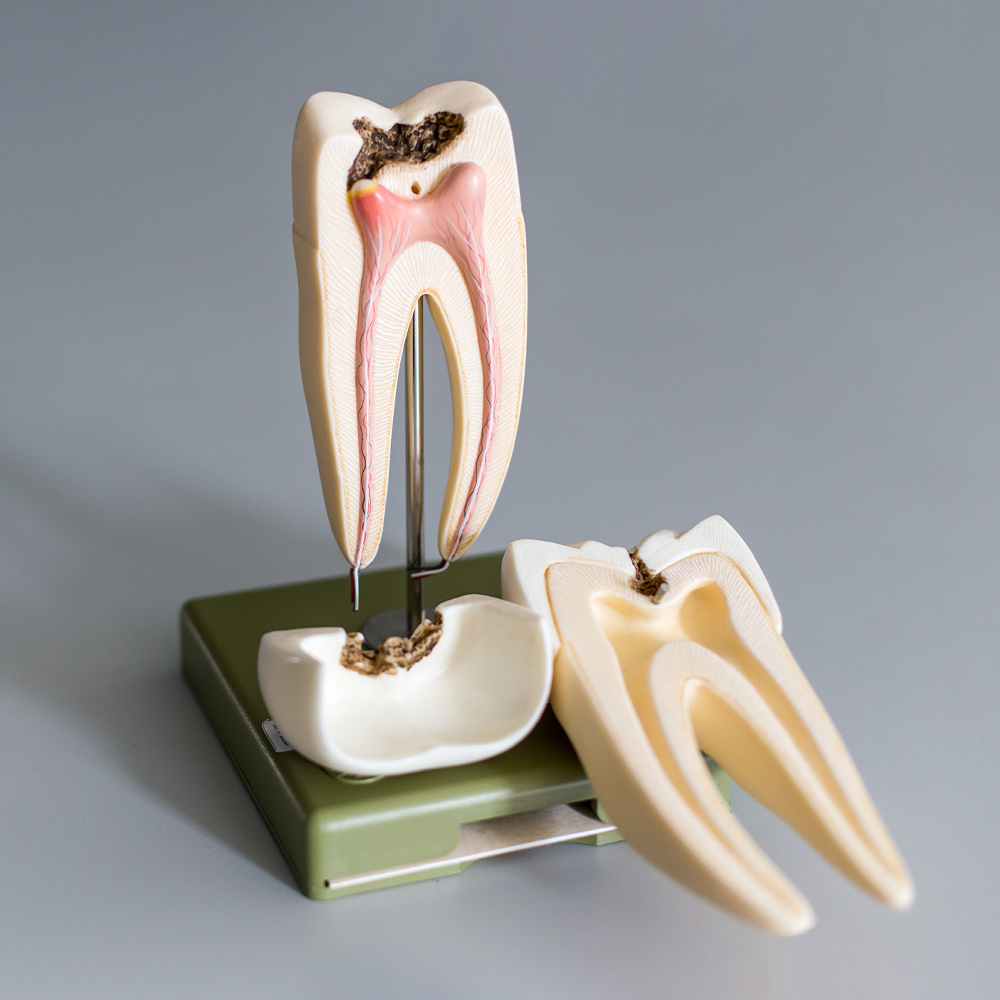 Model of tooth with infected root canal