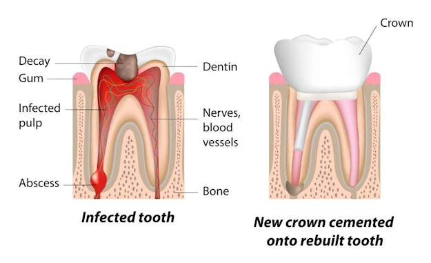Illustration of an infected tooth after root canal therapy.