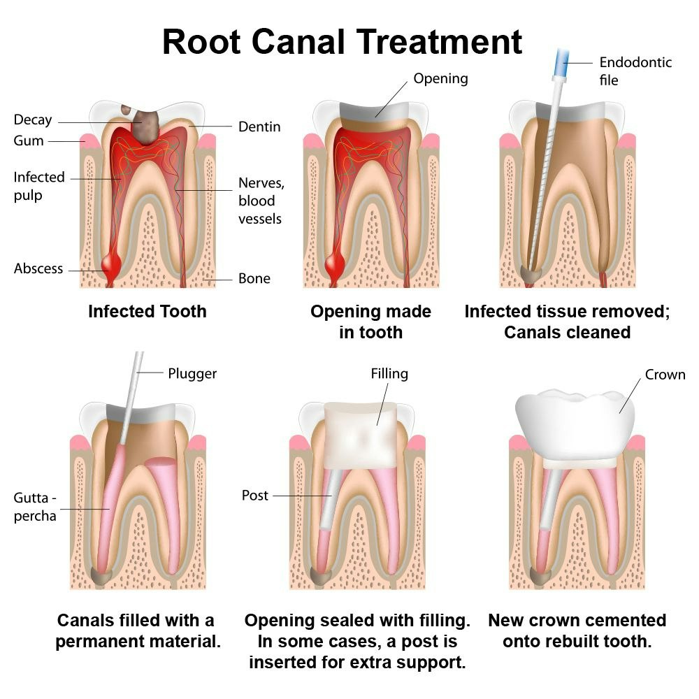 An illustration of root canal therapy treatment