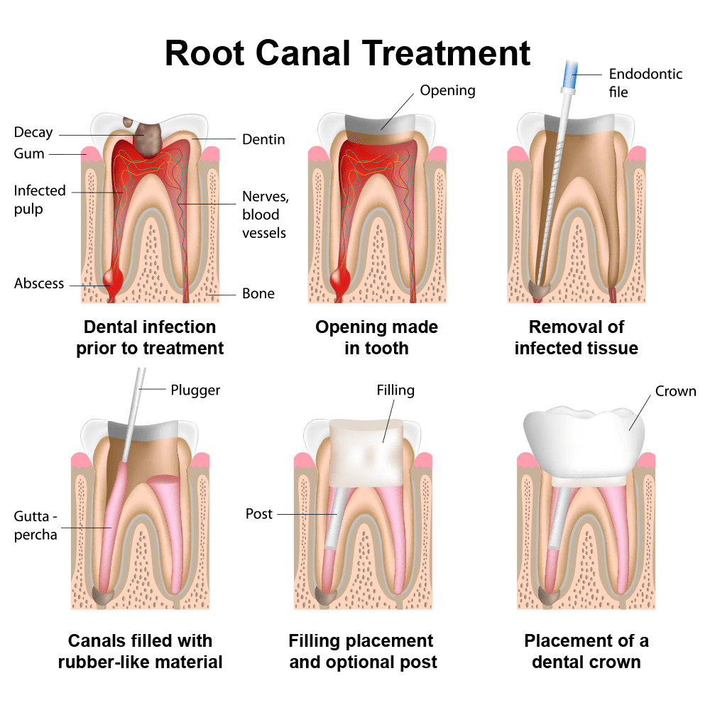 Diagram of the stages of a root canal procedure
