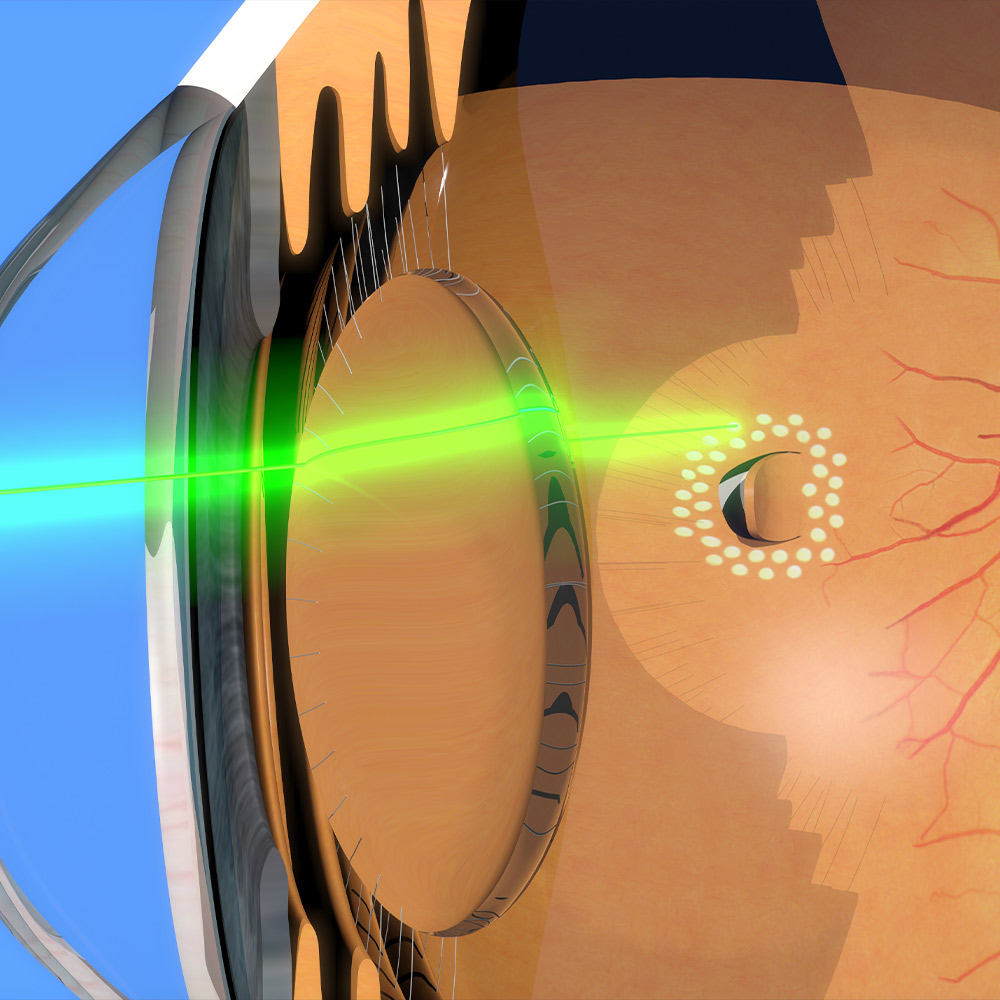 Scatter laser treatment