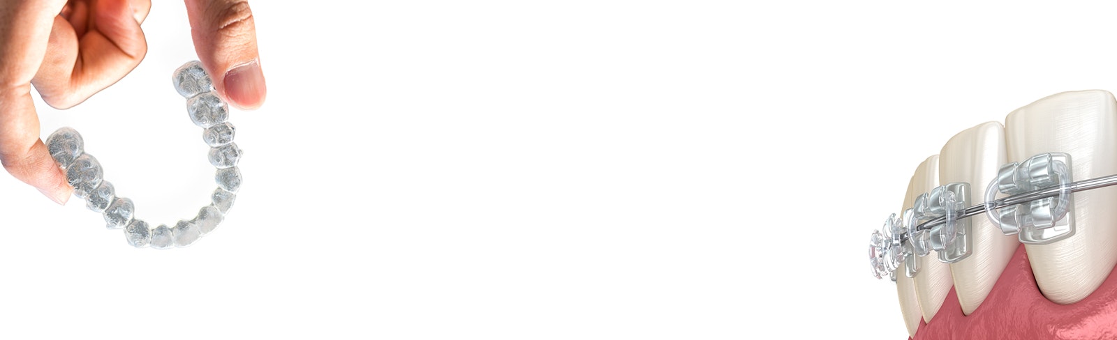Invisalign vs Braces