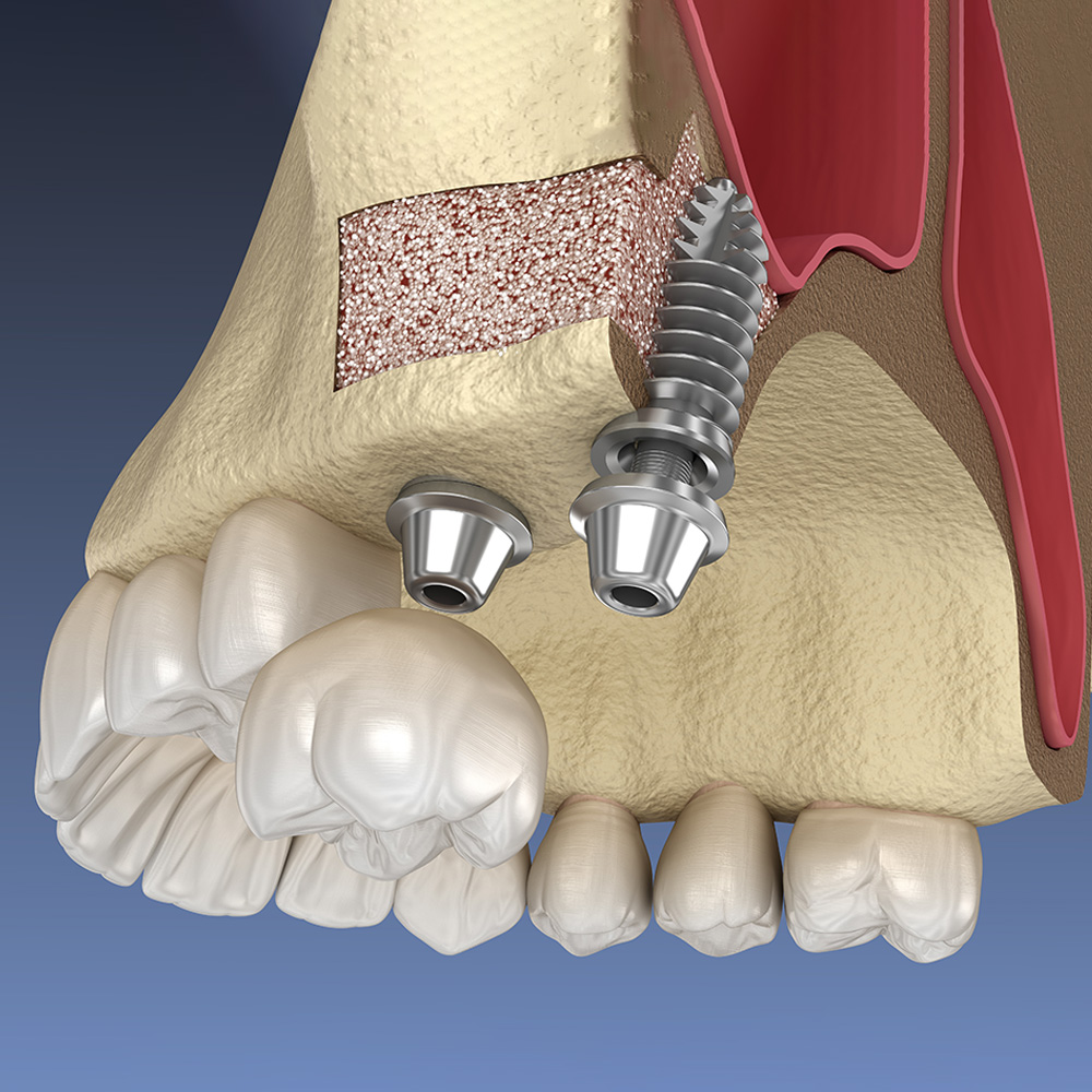 Dental Implants Cost Lakewood, CO - Denver, CO - Colorado ...