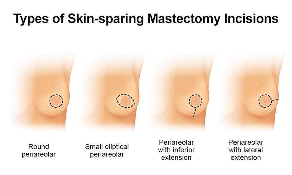 Skin- versus Nipple-sparing Mastectomy - Manhattan, New York