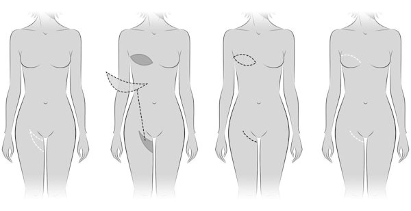 Transverse upper gracilis (TUG) diagram