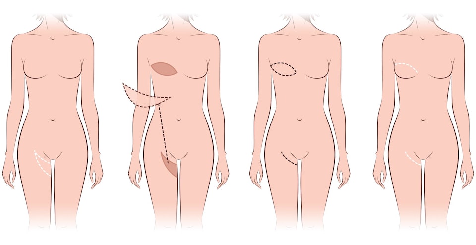 TUG and TAP flap surgery