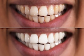 After whitening