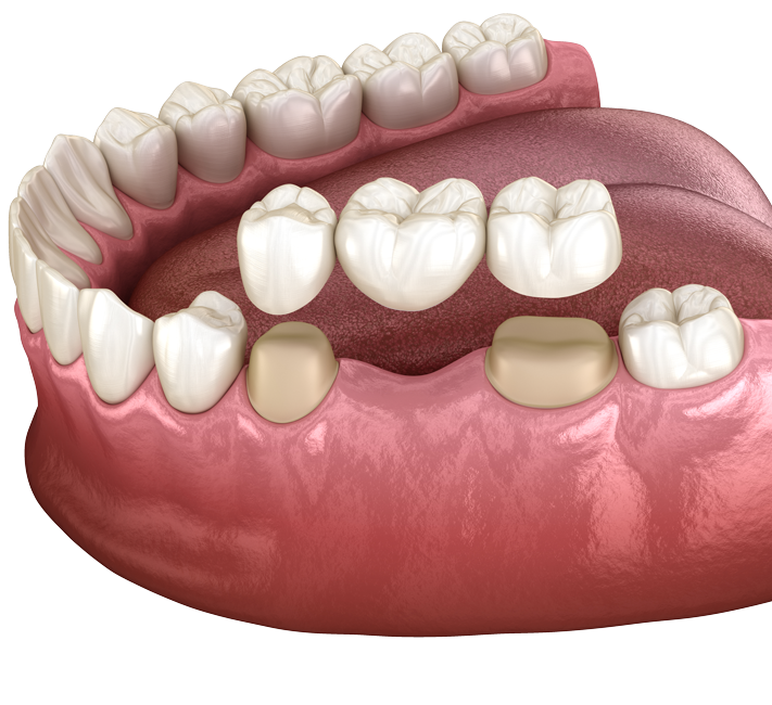 Dental Bridges San Diego, CA - Tooth Bridge - Balboa Dental Care