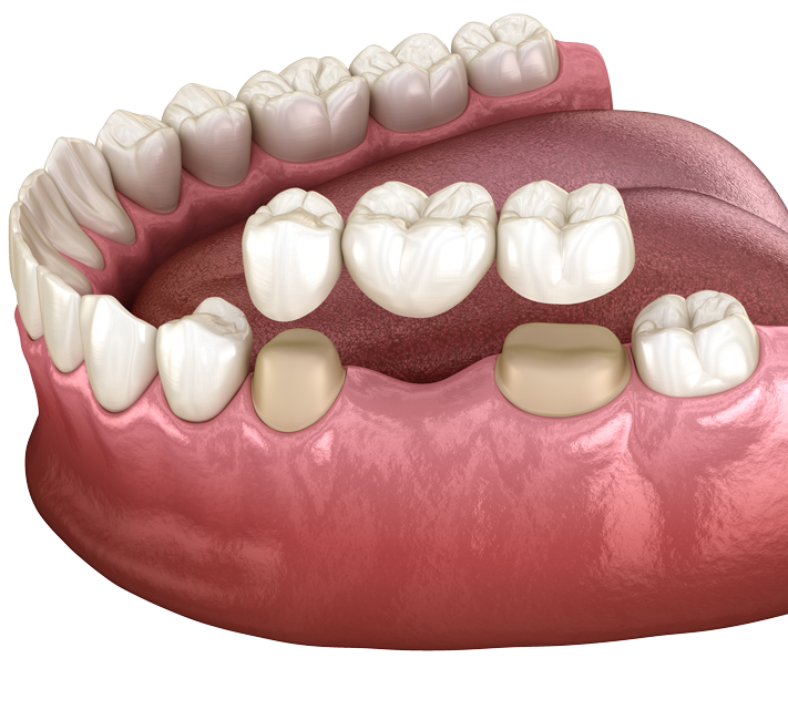 Dental Bridge