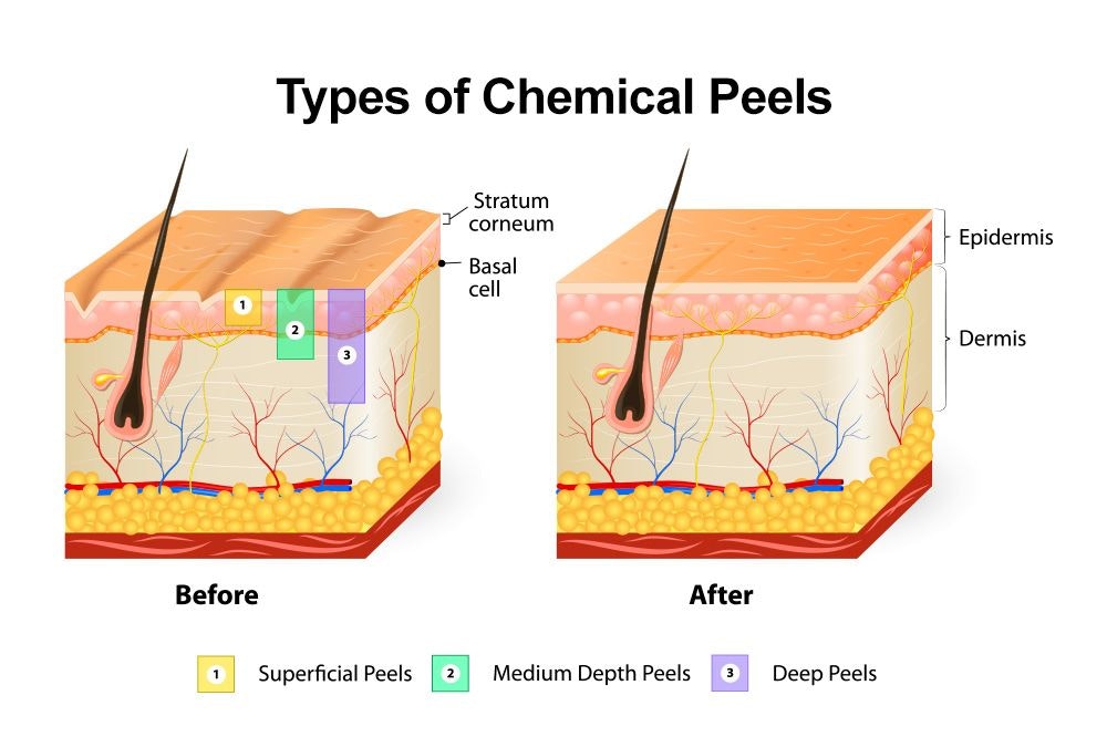 Illustration of levels of a chemical peel