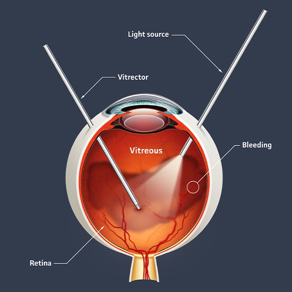 Vitrectomy