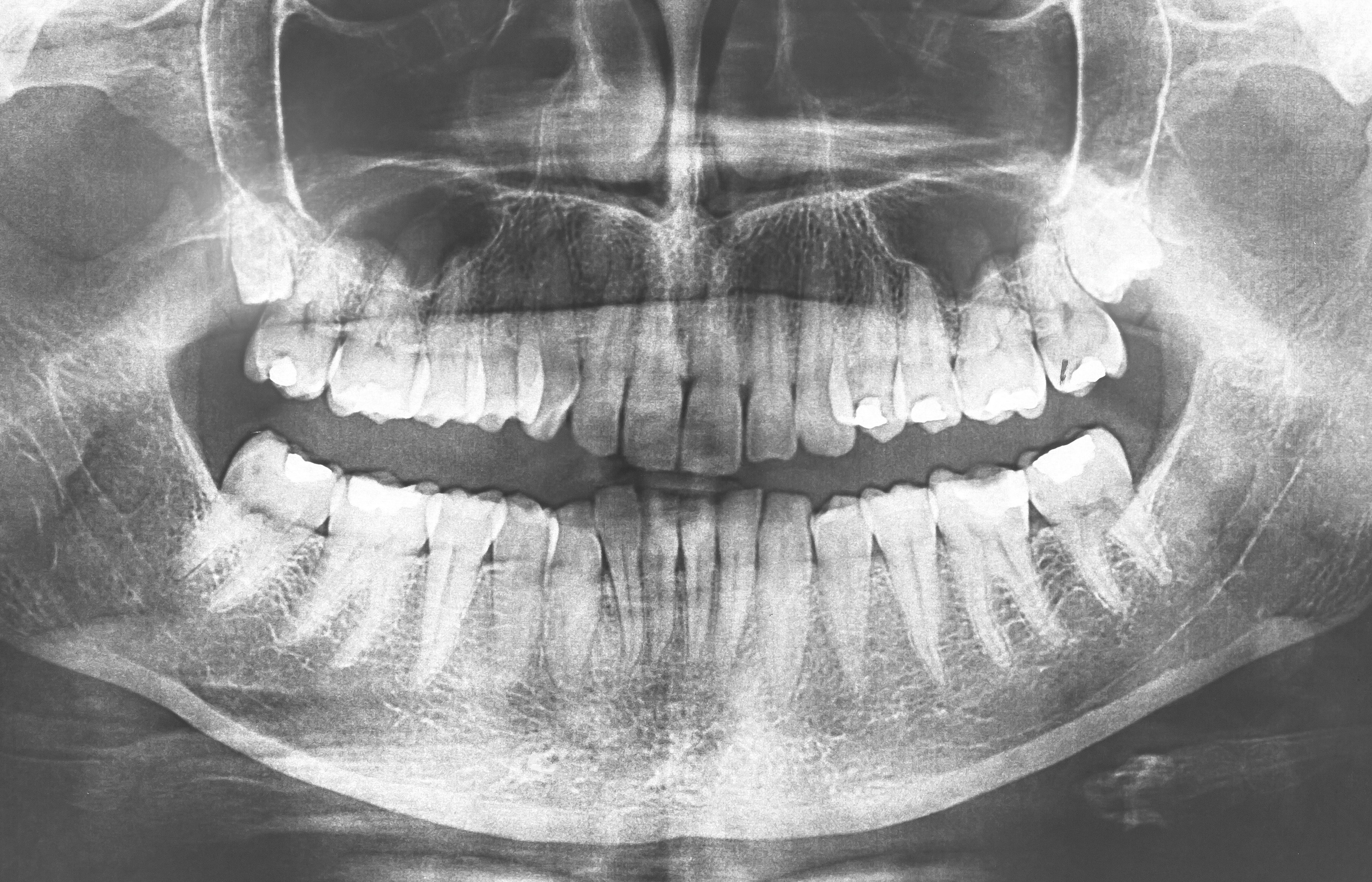 tmj-colorado-springs-co-tmj-treatment-streeter-dental