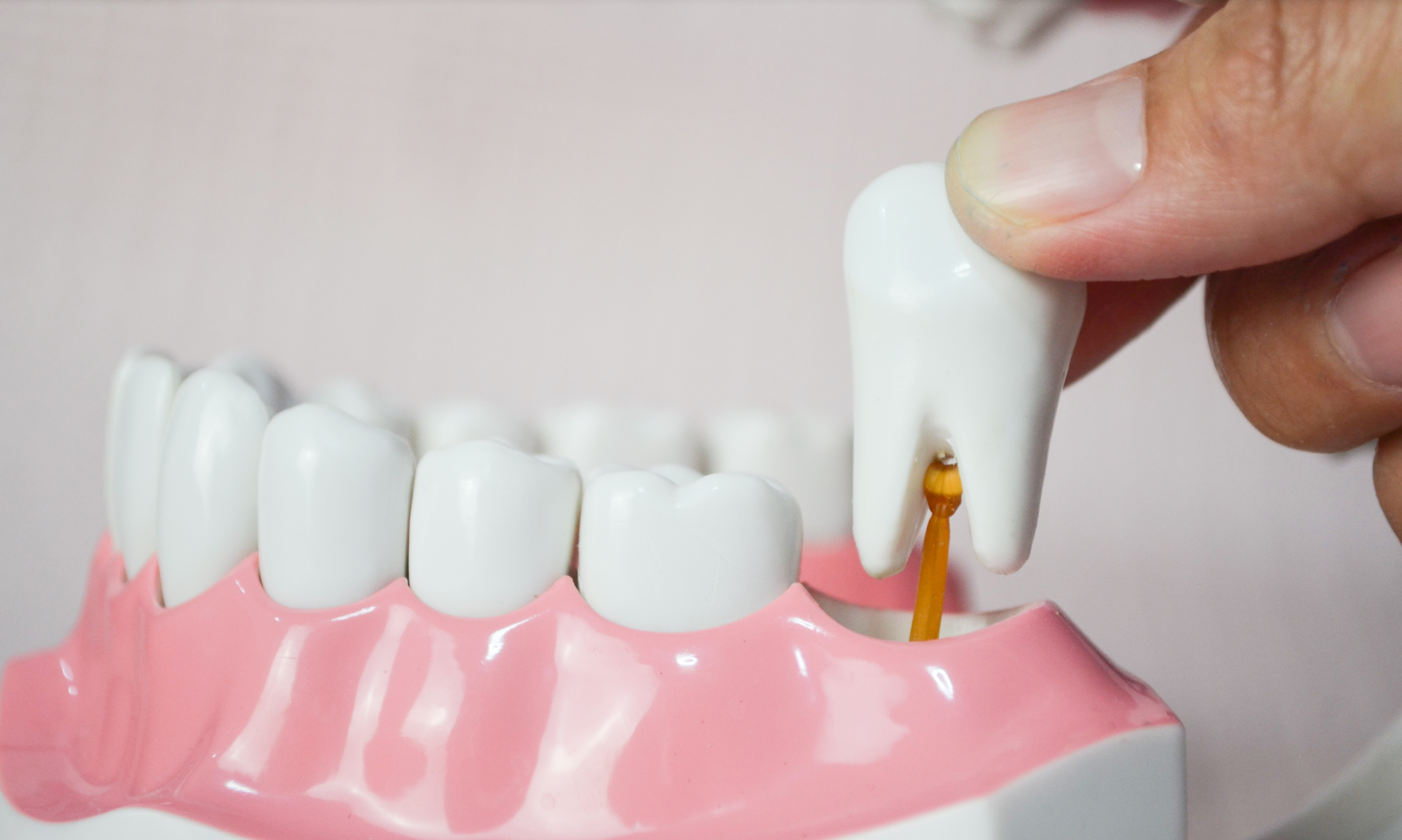 3D model of wisdom tooth being removed