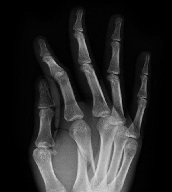 X-ray of injured and healthy hand