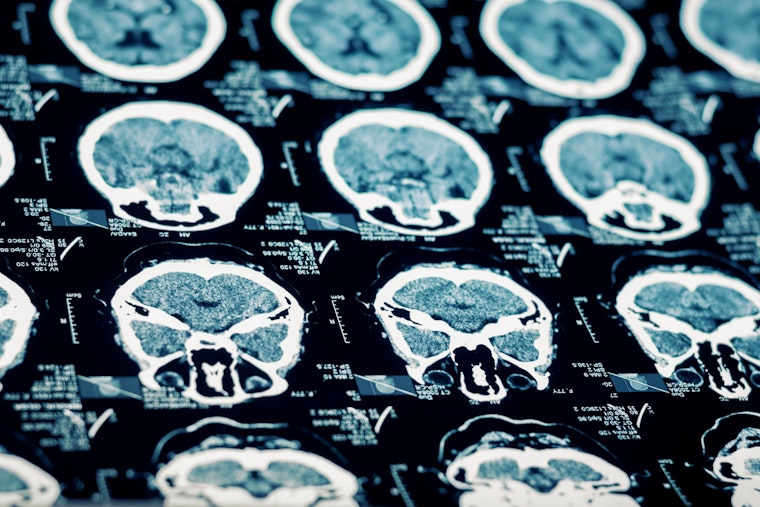 image of brain scan