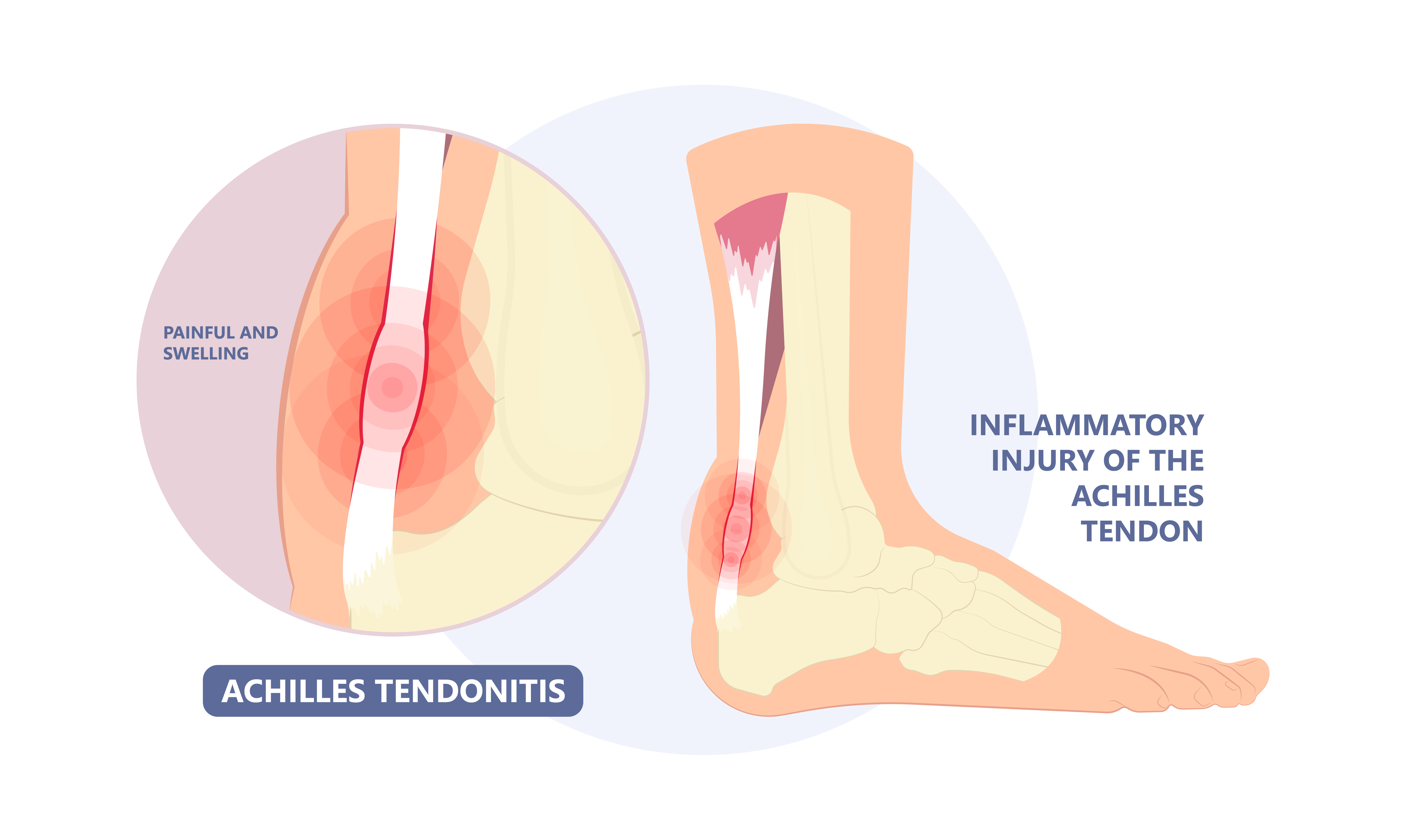 Achilles pain clearance without injury